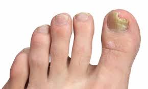 Soak feet for at least 30 minutes. Home Remedies For Toenail Fungus Follow Them