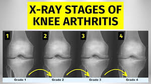 Image result for Knee XRay