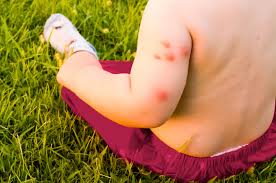 Temukan koleksi 6.000 gambar apel cantik untuk desainmu. Begini Cara Menghilangkan Bekas Gigitan Nyamuk