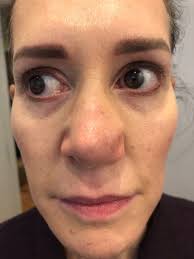 My Primary and Revision Rhinoplasty with Charles East