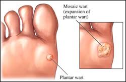 Does it feel like you have pebbles in your shoe? A Look At Painful Plantar Warts