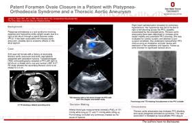 1118 230 Patent Foramen Ovale Closure In A Patient With Platypnea Orthodeoxia Syndrome And A Thoracic Aortic Aneurysm Acc 2019 Eposter