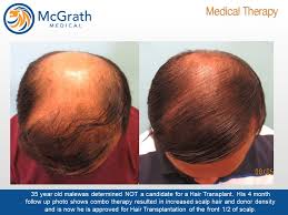 A sufficient amount of purines are naturally made by the body to serve functions in dna, rna, and neurotransmission. Combination Hair Loss Therapy Mcgrath Medical Austin Texas