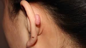 Image result for Keloid