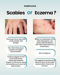 Image result for skin rash similar to scabies