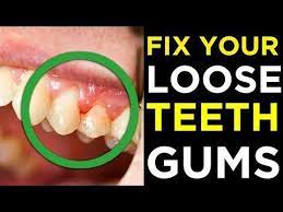 Fix Your Loose Teeth And Gums Amazing Home Remedies To Fix Loose And Shaky Teeth Youtube Loose Tooth Fix Teeth Teeth Remedies