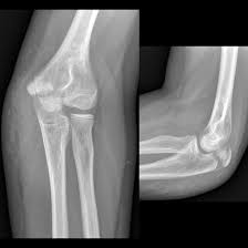 Image result for Elbow XRay