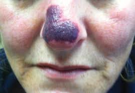It can occur on the skin and mucous membranes, including the lining of the mouth. Painful Purpura And Cutaneous Necrosis Mdedge Dermatology