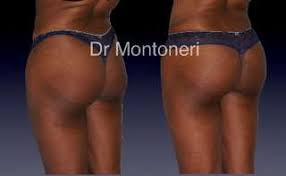 Prix augmentation fesses tunisie par implants fessiers ou par lipomodelage du fessier. Chirurgie Esthetique Fessier Augmentation Des Fesses Plates