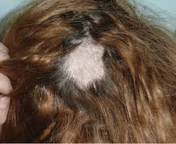 I even bragged a little that i only had minimal hair loss. Pdf Can An Aesthetic Intervention Braided Hair Coil Cause Hair Loss After An Aesthetic Operation Semantic Scholar