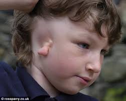 Boy, 9, born with no ear is left delighted after surgeons rebuild it using  tissue from his ribcage