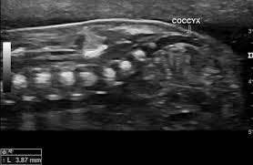 Image result for Spinal Dysraphism