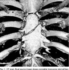 Image result for Sternal Fracture