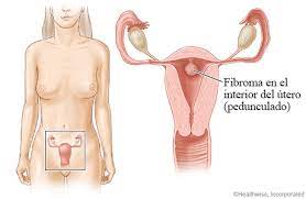 Aunque está compuesto por las mismas fibras musculares lisas de la pared del útero (miometrio), el fibroma dispone de una densidad mucho mayor que la del miometrio normal. Fibroma Uterino En El Interior Del Utero Cigna
