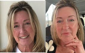 Wow!!! Check out her 1 year results with this skincare🤩 For the majority  of the time, this gal used the Expert Line, but now with the dry, cold  winter in Alberta, she's