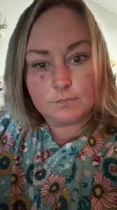 Susie Torres Spider Brown Recluse in Incident