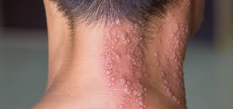 Image result for shingles