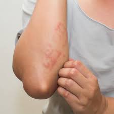 How long for a drug rash to go away. Common Skin Rashes And What To Do About Them