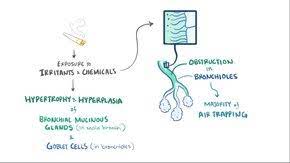 Chronic obstructive pulmonary disease (copd) is a chronic inflammatory lung disease that causes obstructed airflow from the lungs. Ø¯Ø§Ø¡ Ø§Ù„Ø§Ù†Ø³Ø¯Ø§Ø¯ Ø§Ù„Ø±Ø¦ÙˆÙŠ Ø§Ù„Ù…Ø²Ù…Ù† ÙˆÙŠÙƒÙŠØ¨ÙŠØ¯ÙŠØ§