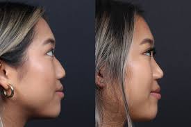 Before & After Photos