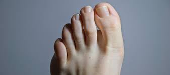 Image result for Toenail Removal