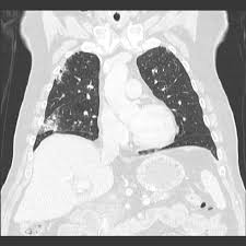 Image result for Pulmonary Intoxicant