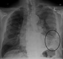 Mesothelioma is a very rare cancer and mesothelioma symptoms can be similar to many other diseases and ailments. Mesothelioma Wikipedia