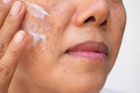 Melasma is a common concern for many women and some men. Pregnancy Melasma Chloasma Causes And Treatment