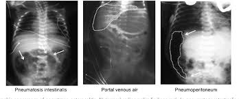 Image result for Necrotizing Enterocolitis