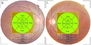 early treatment diabetic retinopathy study etdrs chart of