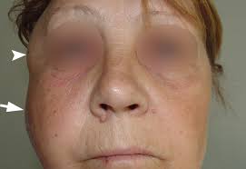 Image result for phlegmon on face)