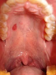 On one ocassion when i wasn't well they became red, but i don't think they are normally like that. Tiny Bumps Roof Of Mouth