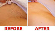 Boils Treatment