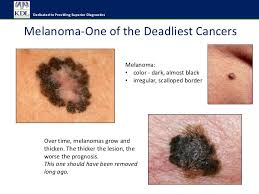 The most usual indication of skin cancer is change in the skin's appearance. Do I Have Skin Cancer