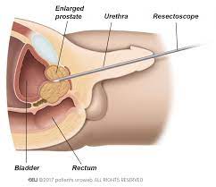 Transurethral resection and transurethral incision of the prostate. Transurethral Resection Of The Prostate Turp Patient Information