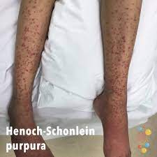 Allergic vasculitic purpura this is caused by inflammation and infiltration of the blood vessel wall as an anaphylactic reaction to a number of physical and chemical stimuli, including infections. Henoch Schonlein Purpura Skin Deep