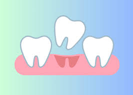 Image result for Tooth Avulsion