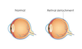 Image result for Retinal Detachment
