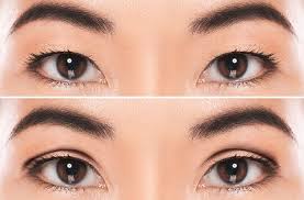 We did not find results for: Double Eyelid Surgery All About Vision