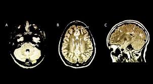 En la esclerosis múltiple la resonancia magnética nos sirve para el diagnóstico y para el seguimiento de la enfermedad. Identifican A Ninos En Alto Riesgo Para Esclerosis Multiple Rm Medimaging Es