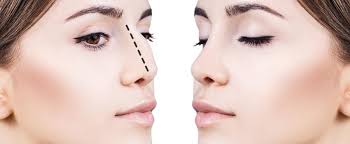 Después de 7 años de experiencia y cientos de pacientes operados con esta técnica. Nasenkorrektur Fakten Kosten Und Arzte Zur Rhinoplastik Hockernase Asthetisch Korrigieren