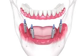 Image result for dentures