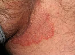 Image result for genital herpes