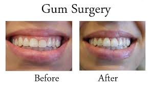 Classic Smiles Dental On Instagram Have A Gummy Smile The Team At Classic Smiles Can Help You Out Here S A Before Gum Surgery Smile Dental Cosmetic Dentist