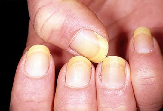 Dấu hiệu bệnh qua màu sắc móng tay | VOV.VN