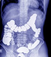 The program's aim is early detection of bowel cancer in individuals before any serious symptoms appear. What To Eat And What To Avoid To Reduce Your Risk Of Bowel Cancer Direct Endoscopy