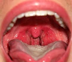 Glavnye Vidy Anginy I V Chem Ih Opasnost Telegraf