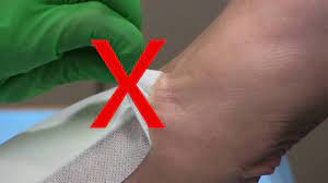 The pressure from the water should be enough to. Medical Adhesive Related Skin Injury Youtube