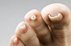 Nagelpilz Ursachen Und Mittel Gegen Nagelpilz Die Mannerapotheke