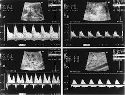 Image result for Neonatal Circulation Assessment